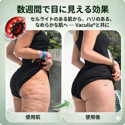 Vaculia™ アンチセルライトマッサージャー