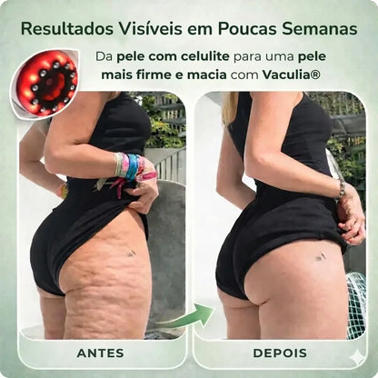 Massageador Anticelulite Vaculia™