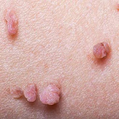 Common Skin Tag