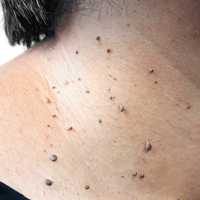 <strong>Pigmented Skin Tag</strong>